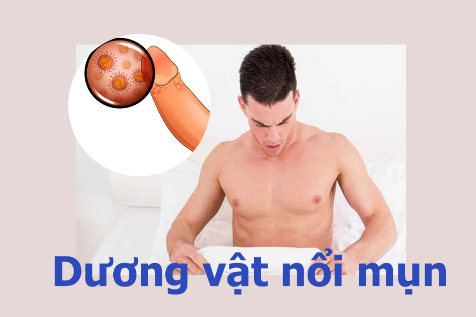 NGUY CƠ Dương vật nổi mụn là bệnh gì Có nguy hiểm không